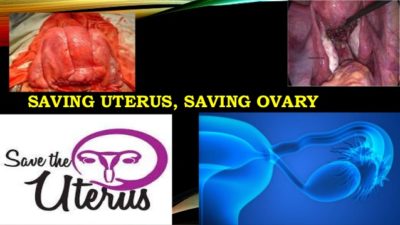 save the uterus